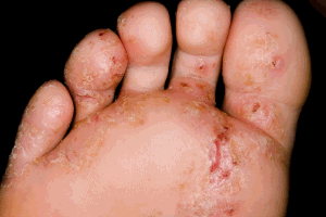 identifying skin rashes #11