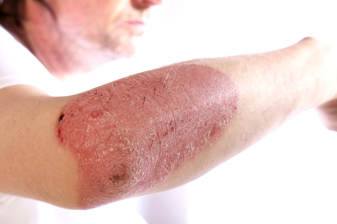 Common Skin Disorders - Healthline