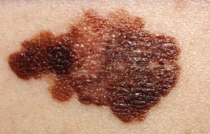 A picture of a skin melanoma