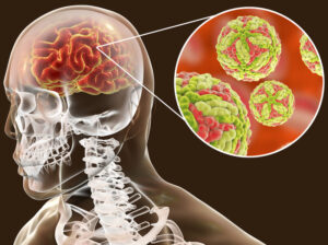 Study: Japanese Encephalitis Controlled by Homeopathic Belladonna