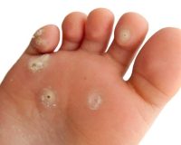 Warts: Treating Them with Homeopathy 5