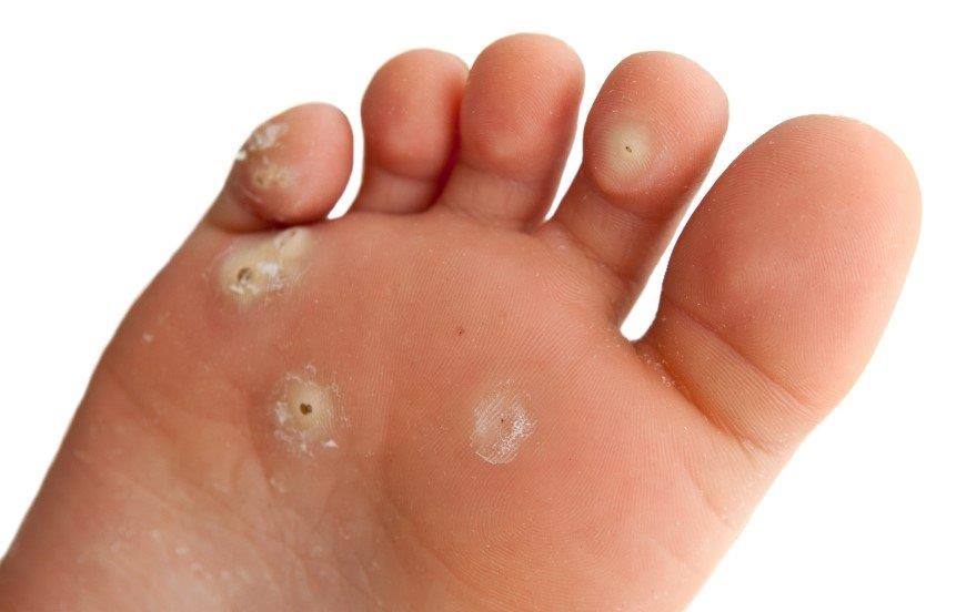 Veruca foot infection treatment - Veruca foot infection