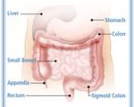 A Homeopathic Approach to Inflammatory Bowel Disease – Crohn’s and Colitis 1