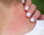 Malaria Homeopathic Prevention for Malaria Homeopathic Prevention for Malaria 1