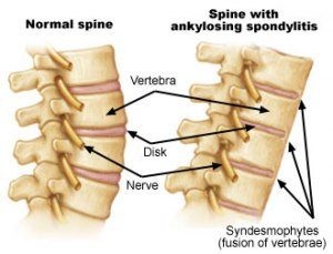 Homeopathic Remedies for Ankylosing Spondylitis