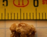 kidneystone zps5b5d175e No Match for Homeopathy No Match for Homeopathy 1