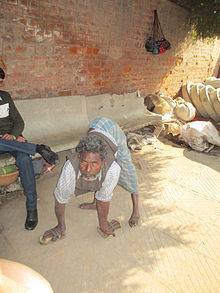 Miracle homoeopathy drug brings hope for leprosy patients 16