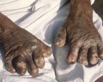 Homeopathy helps 80 % of leprosy patients 2
