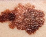 Melanoma and homeopathy - what does the research show? 9