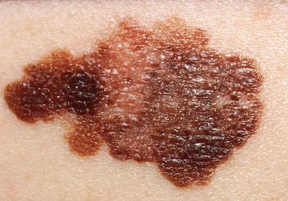Melanoma and homeopathy - what does the research show? 4