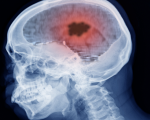 Brain Tumour Homeopathy and Brain Tumours Homeopathy and Brain Tumours 1