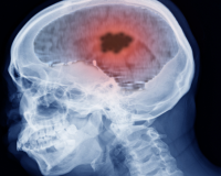 Homeopathy and Brain Tumours 4