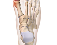STUDY - Homeopathic Arnica Compared to a NSAID Following Bunion Surgery 3
