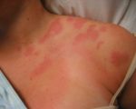 shingles1 Wipe out shingles with easy-to-use homeopathic remedies Wipe out shingles with easy-to-use homeopathic remedies 1