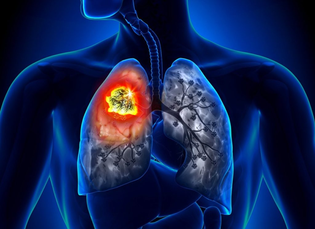Lung_Cancer