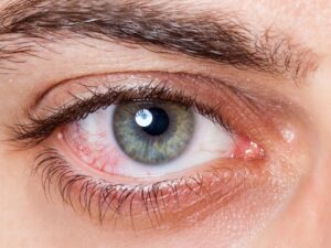 Pink Eye No More