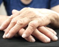 Arthritis: Homeopathic Treatment 3