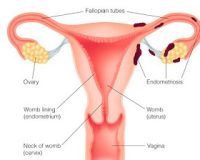 Homeopathy and Endometriosis 2