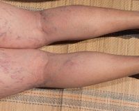 Remedies for Varicose Veins 3