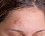 Acne Remedies for acne Remedies for acne 1