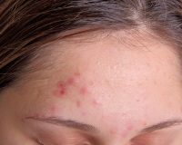 Remedies for acne 1