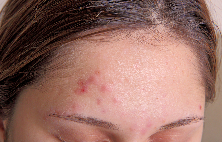 Remedies for acne 9