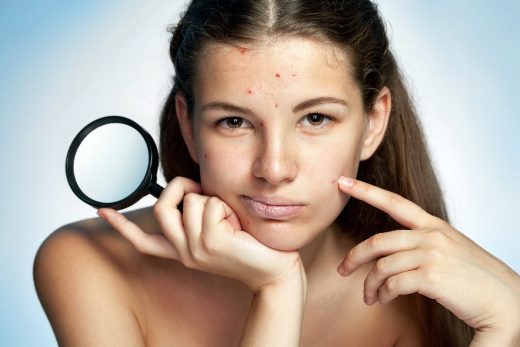 girl_with_acne