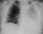 Collapsed Lung and Homeopathy 1