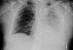 An image showing a collapsed lung