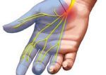 Homeopathy for Carpal Tunnel 2