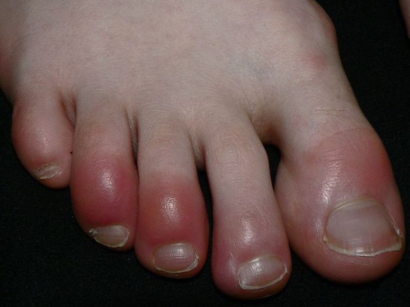 Homeopathy for Chilblains 2