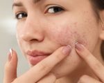 Homeopathy for Acne 8