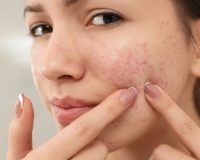 Homeopathy for Acne 1