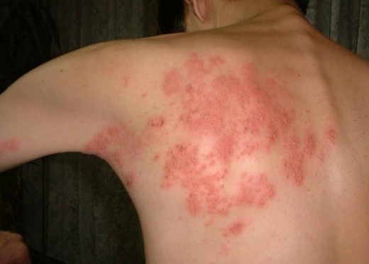 Homeopathic Help for Shingles 2