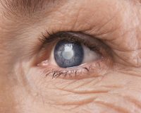 Remedies for Glaucoma 5