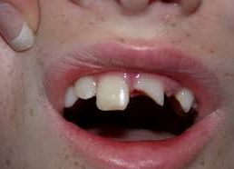 Remedies for Mouth Injuries 2