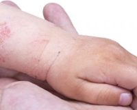 Case Presentations: Pediatric Atopic Dermatitis 2
