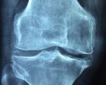 Knee Pain A Case of Knee Pain Treated Homeopathically A Case of Knee Pain Treated Homeopathically 1