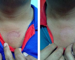 Remedies for Fungal & Ringworm Infections 2