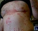 Case: A Psoriasis Remedy 5
