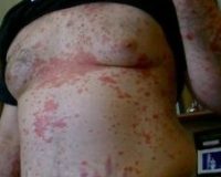 Case: A Psoriasis Remedy 3