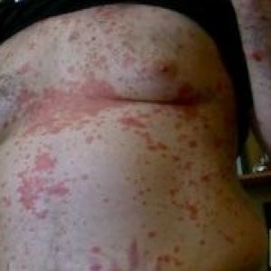 Case: A Psoriasis Remedy