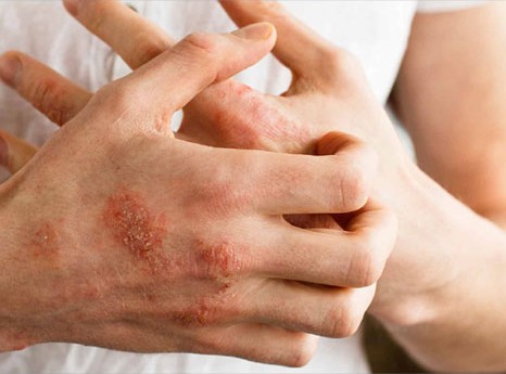 Homeopathy for Eczema 2