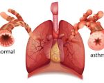 Asthma Homeopathy and Asthma Homeopathy and Asthma 1