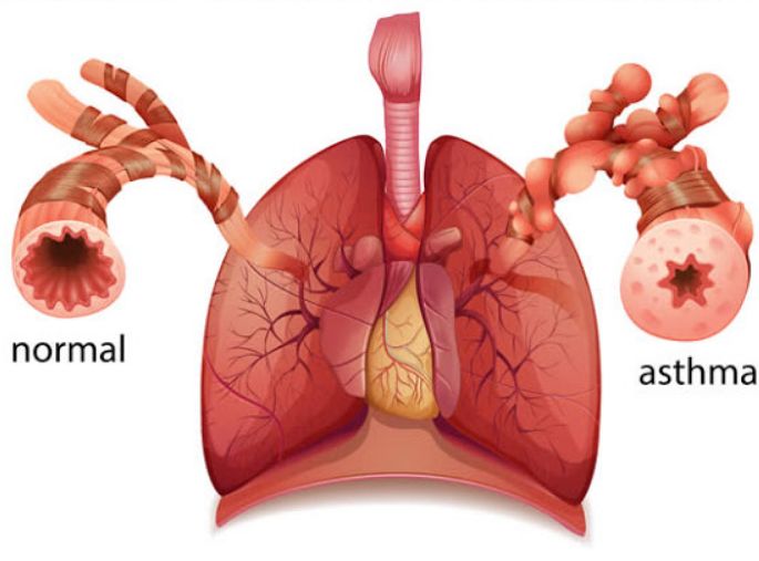 Homeopathy and Asthma 2