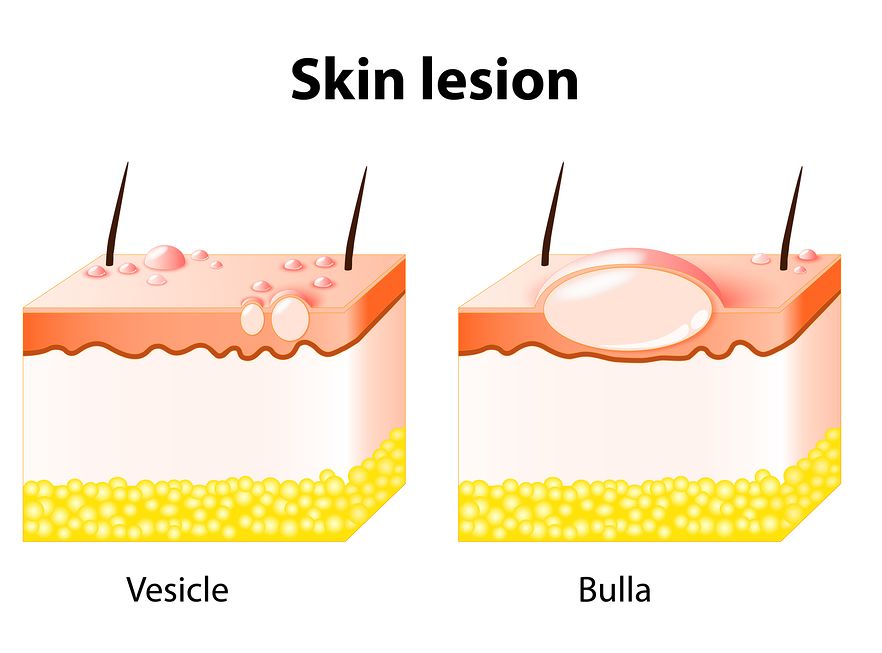 A Case Of Bullous Pemphigoid Homeopathy Plus