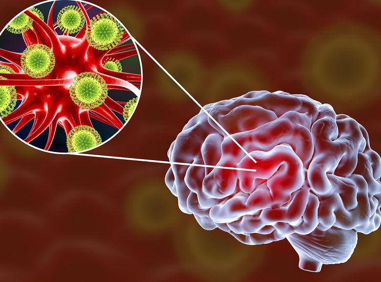 Case Report: Encephalitis and Pneumonia 2