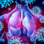 Lung Infection with Pneumonia (Viral)