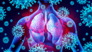 Lung Infection with Pneumonia (Viral)