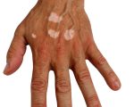 Remedies for Vitiligo 2
